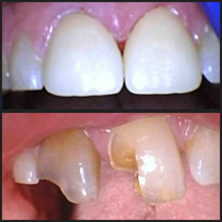 before and after - STL Mid-County Dental